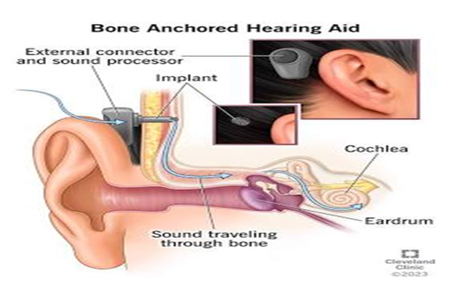 Do Hearing Aids Restore Full Hearing Ability