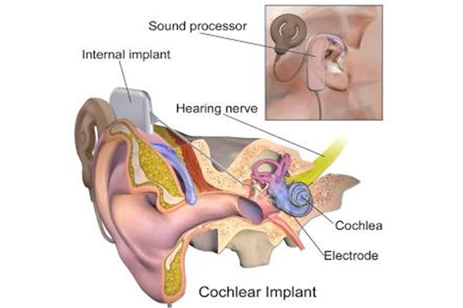 Do Hearing Aids Restore Full Hearing Ability
